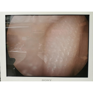 Rigid Endoscope 30&deg; &ndash; Burkart &ndash; HDscope 30&deg;/WA &ndash; Starres Endoskop 30&deg;